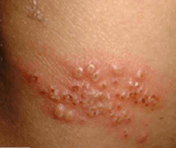 std rash pictures