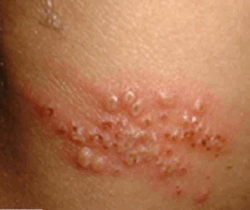 Genital Herpes Outbreak